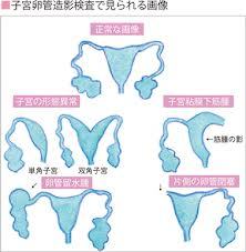 卵管造影でわかること.jpg