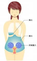腹水が溜まる.jpg