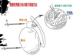閉塞性無精子症の精子採取.jpg