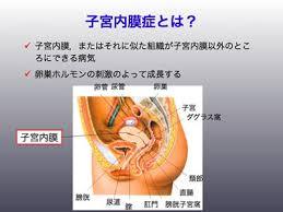 子宮内膜症.jpg